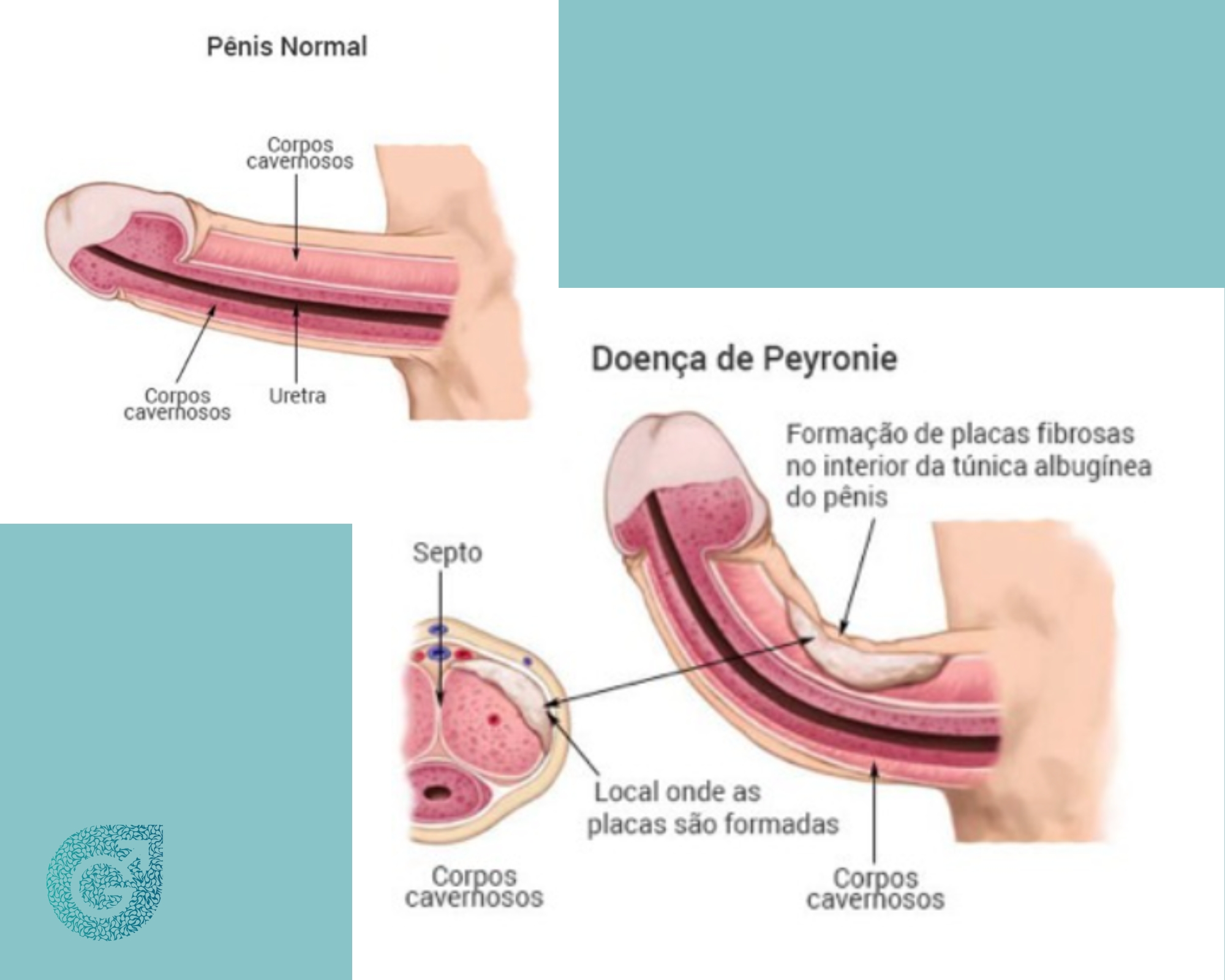 Demonstração da fibrose peniana levando a Doença de Peyronie