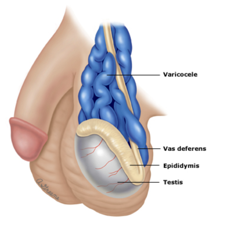 Demonstração das veias dilatadas no lado esquerdo, caracterizando a varicocele.